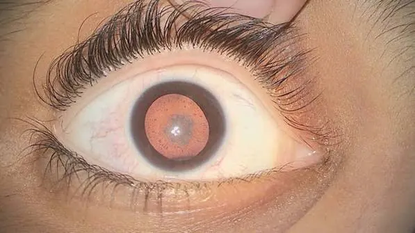 Congenital Cataract