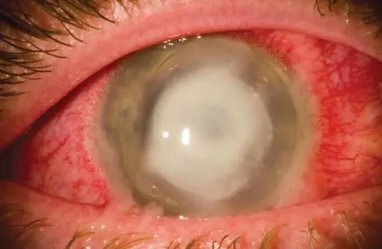 Corneal Infection