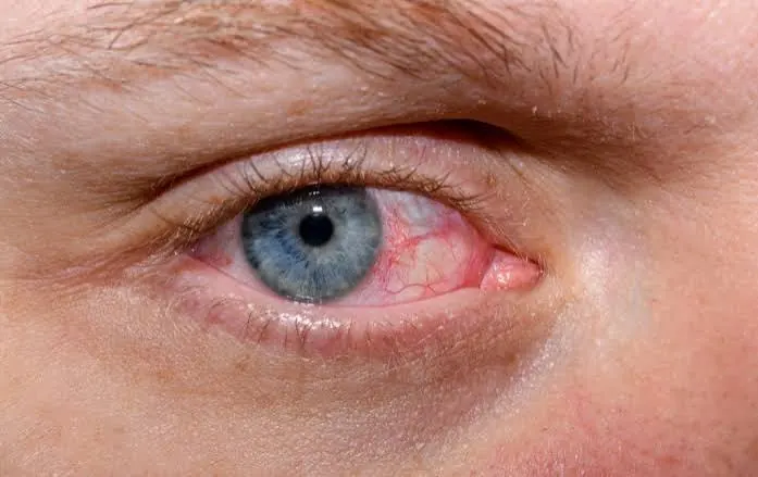Dry Eye Syndrome