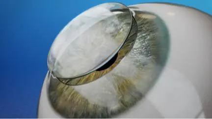Corneal Transplant