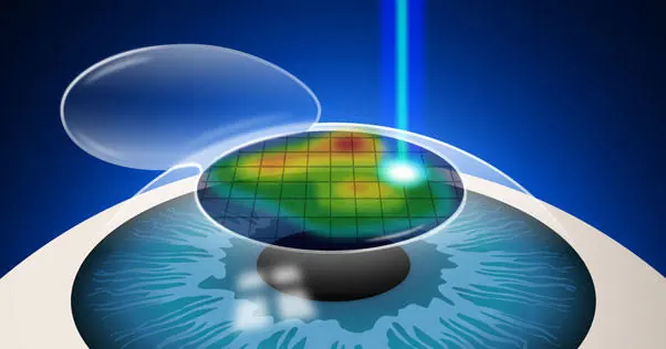 Contoura Vision LASIK