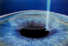 SMILE bladeless LASIK