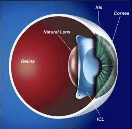 Implantable Contact Lens