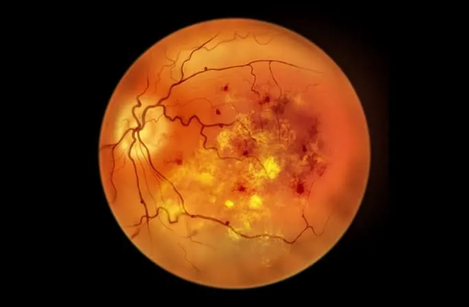 Diabetic Retinopathy