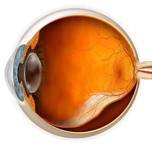 Retinal Detachment