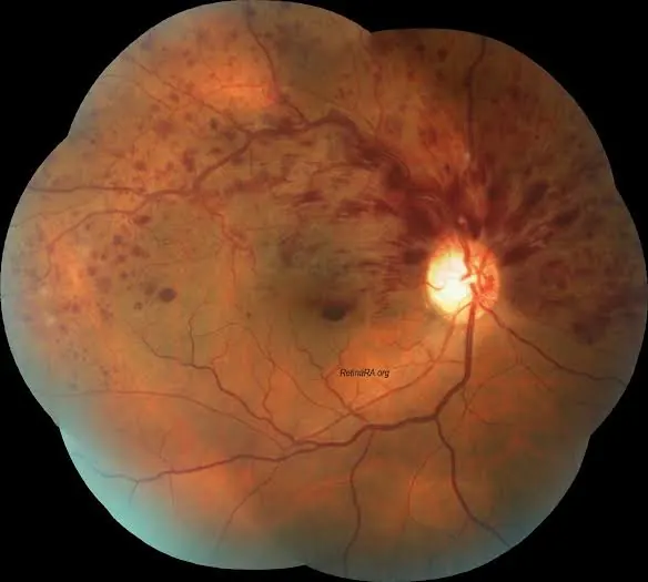 Retinal Vein Occlusion