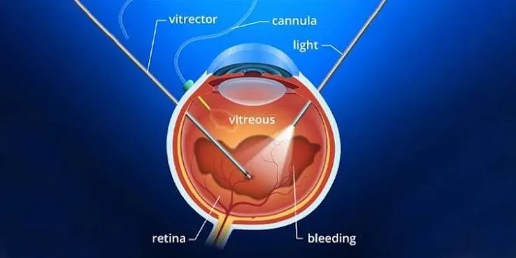 Retina surgery